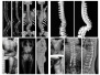 八小时手术 十年畸形一朝矫正 二附院成功完成一例复杂成年脊柱侧弯矫形手术