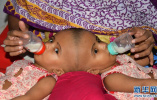 孟加拉国头部连体女婴　准备接受分离手术